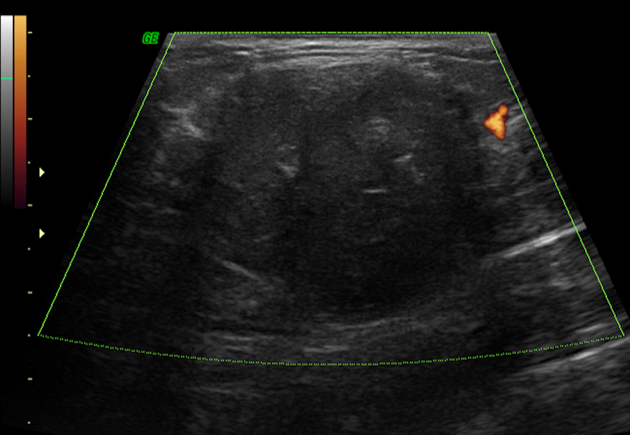 A ultrassonografia identificou um nódulo oval, heterogêneo, circunscrito, paralelo à pele, sem fluxo ao Doppler, medindo 3,2 x 2,8 x 2,9 cm, corresponde ao nódulo palpável. Classificação: achado provavelmente benigno (BI-RADS® 3). Outros diagnósticos que frequentemente mostram esses achados ultrassonográficos são os adenomas lactantes e os fibroadenomas.