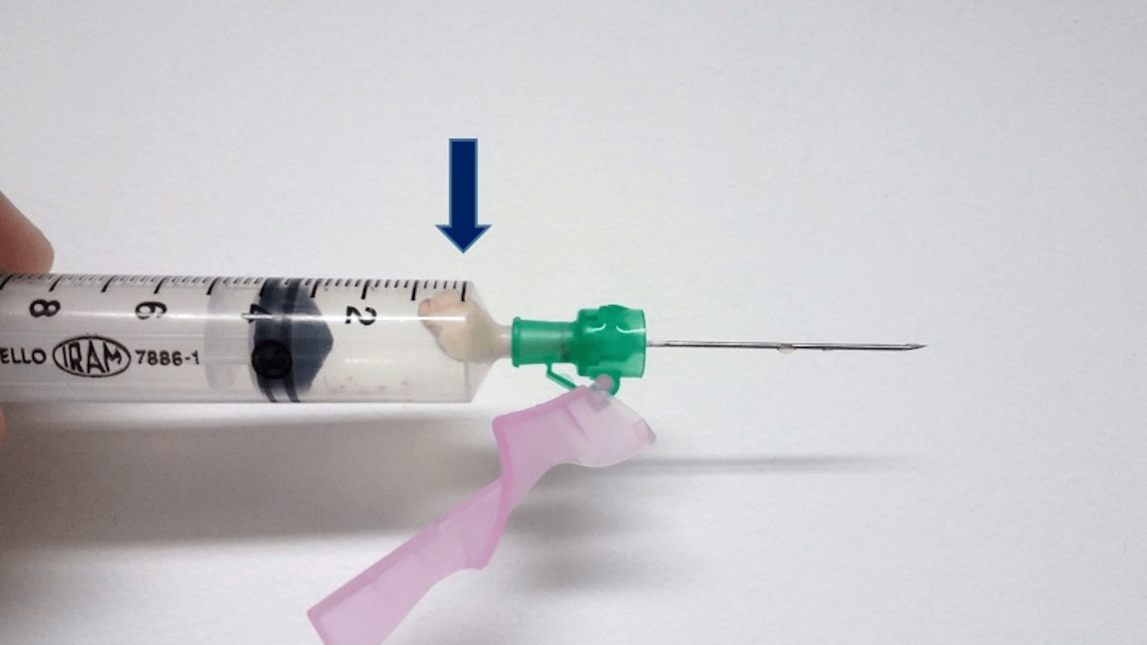 Punção aspirativa por agulha fina (PAAF) com obtenção de material lácteo, o que confirmou o diagnóstico clínico e mamográfico de galactocele. Nesse caso não foi possível esvaziar completamente o conteúdo do cisto. A punção foi diagnóstica, mas não foi terapêutica.